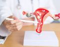 Esta anomalía fisiológica impide que los ovarios liberen óvulos de forma regular y predecible, afectando directamente la fertilidad, la planificación familiar y el ciclo natural del cuerpo femenino. ESPECIAL
