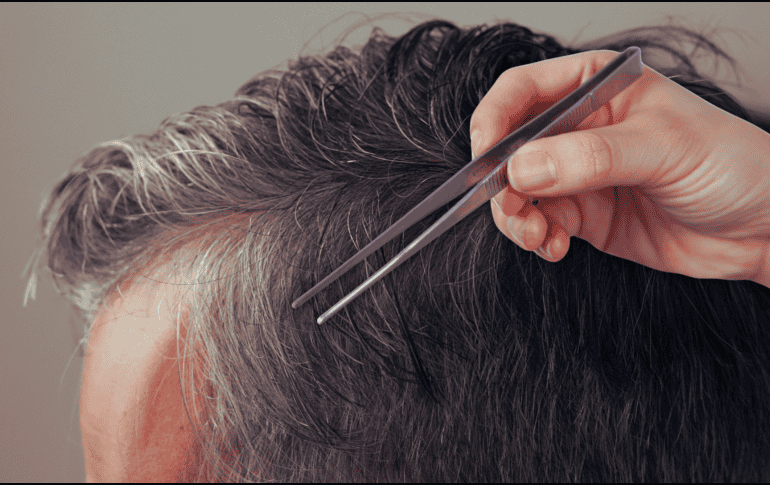 La extracción mecánica y repetida puede inflamar de manera severa esta delicada estructura anatómica, alterando su funcionamiento normal. ESPECIAL / CANVA