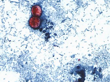 Esta fotografía tomada a través de un microscopio y difundida por los CDC muestra Cyclospora cayetanensis oocysts de una muestra de heces. AP/ARCHIVO