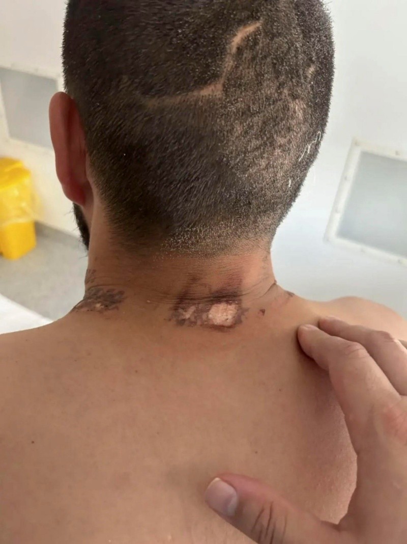 &nbsp;El árbol se partió y el caballo muerto, cayó sobre la pierna del hombr, quien presenta también cicatrices en el cuello y la nuca por culpa del rayo. EFE / ministro de Sanidad de la región de Altái