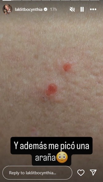 Cynthia Klitbo compartió a través de sus redes sociales la que fue mordida por una una araña viuda negra. INSTAGRAM/ laklitbocynthia 